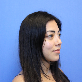 25-34 year old woman treated with Revision Rhinoplasty after 3377798