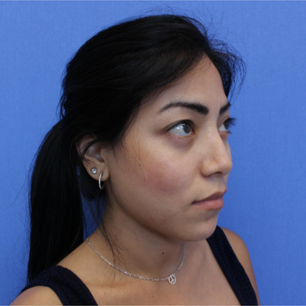25-34 year old woman treated with Revision Rhinoplasty before 3377798