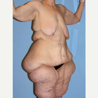 50 Year Old Female Exteme Body Lift Patient before 2400619