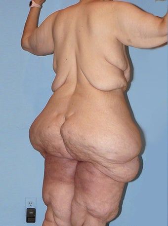 50 Year Old Female Exteme Body Lift Patient 2400619