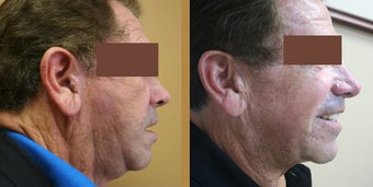 Mini Face Lift before 1165747
