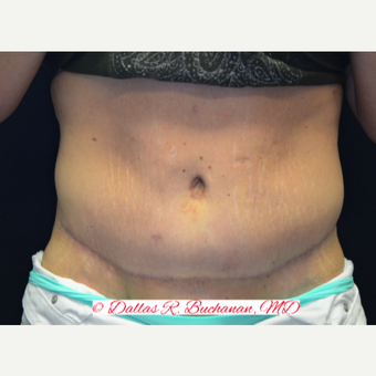 35-44 year old woman treated with Tummy Tuck after 3242261