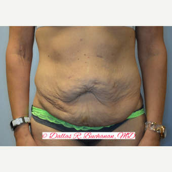 35-44 year old woman treated with Tummy Tuck before 3242261