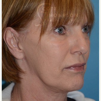 55-64 year old woman treated with MACS Facelift after 3664215
