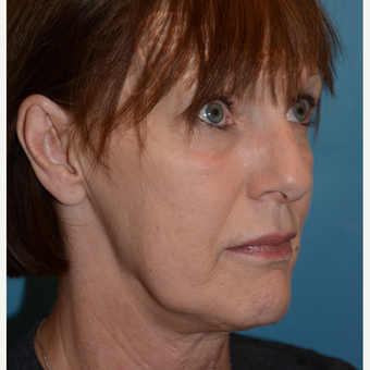 55-64 year old woman treated with MACS Facelift before 3664215