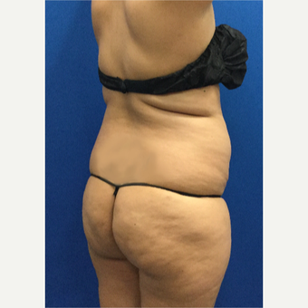 35-44 year old woman treated with Brazilian Butt Lift before 3698011