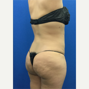 35-44 year old woman treated with Brazilian Butt Lift after 3698011