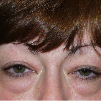45-54 year old woman treated with Eyelid Surgery before 3384084