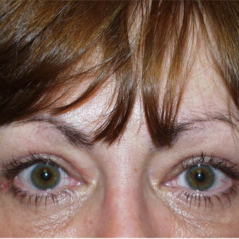 45-54 year old woman treated with Eyelid Surgery after 3384084
