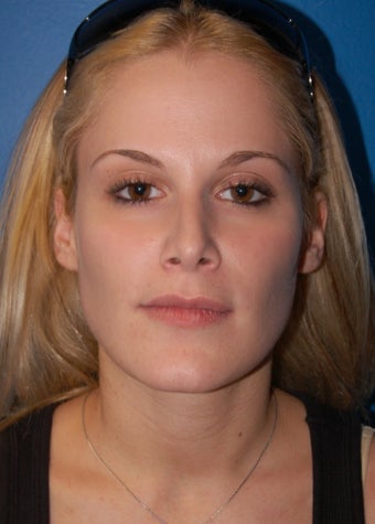 Facial Fat Grafting: Case #3 after 902844