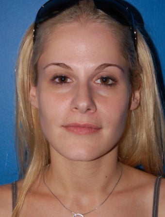 Facial Fat Grafting: Case #3 before 902844