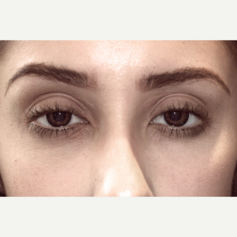 25-34 year old woman treated with Drop-and-Lift before 3151829