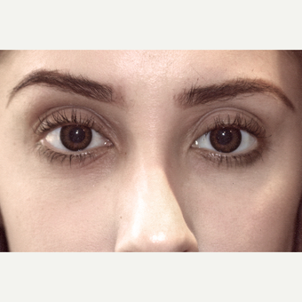 25-34 year old woman treated with Drop-and-Lift after 3151829