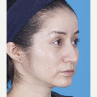 25-34 year old woman treated with Rhinoplasty after 3159515