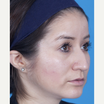 25-34 year old woman treated with Rhinoplasty before 3159515