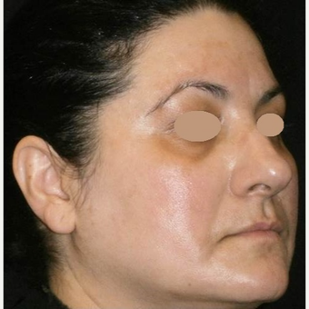 45-54 year old woman treated with Laser Treatment after 3089537