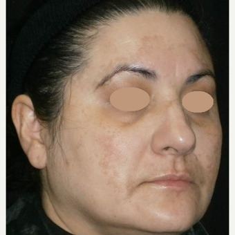 45-54 year old woman treated with Laser Treatment before 3089537