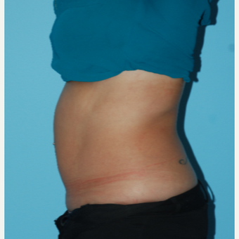 26 year old woman wanted to rid of fat with SculpSure after 3065471