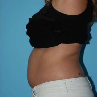 26 year old woman wanted to rid of fat with SculpSure before 3065471