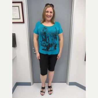 25-34 year old woman treated with Duodenal Switch after 2018144