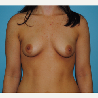 25-34 year old woman treated with Breast Augmentation before 3041046