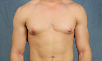 23 year old with gynecomastia treated with chest wall liposuction and pull-through excision via minimal incisions before 1383605