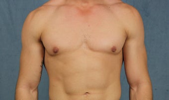 23 year old with gynecomastia treated with chest wall liposuction and pull-through excision via minimal incisions after 1383605