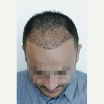 33 years old man treated with FUE Hair Transplant, 3071 Grafts before 2453996