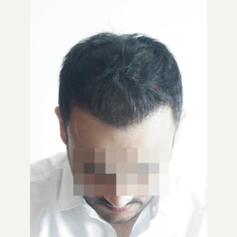 33 years old man treated with FUE Hair Transplant, 3071 Grafts after 2453996