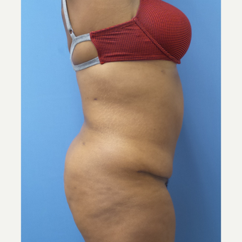 35-44 year old woman treated with Tummy Tuck after 3168321