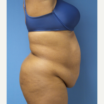 35-44 year old woman treated with Tummy Tuck before 3168321
