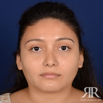 Rhinoplasty after 1357431