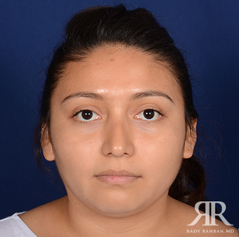 Rhinoplasty before 1357431