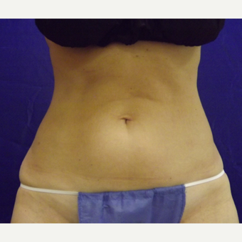 52 year old woman treated with SculpSure in abdomen before 2814889
