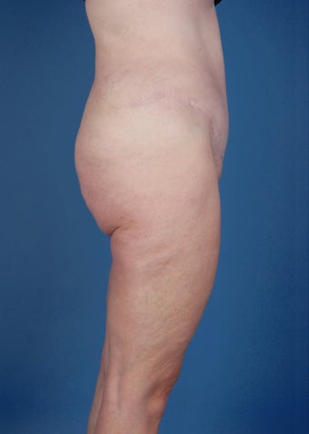 Abdominoplasty (Tummy Tuck) after 260049