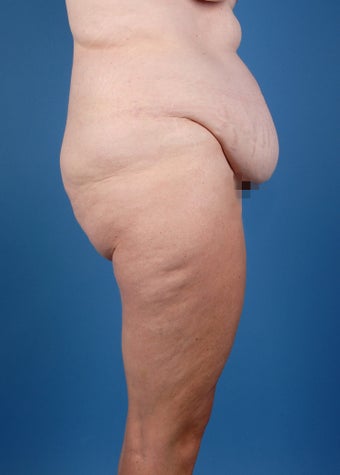 Abdominoplasty (Tummy Tuck) before 260049