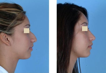 Closed Rhinoplasty before 93642