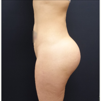 25-34 year old woman treated with Butt Lift using 712cc Round Silicone Implants after 3259577