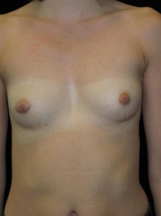 23-24 year old Breast Augmentation before 3103563