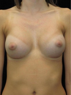 23-24 year old Breast Augmentation after 3103563