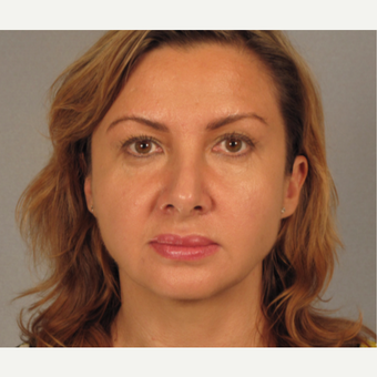 45-54 year old woman treated with Facelift before 3724929