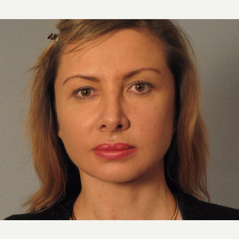 45-54 year old woman treated with Facelift after 3724929