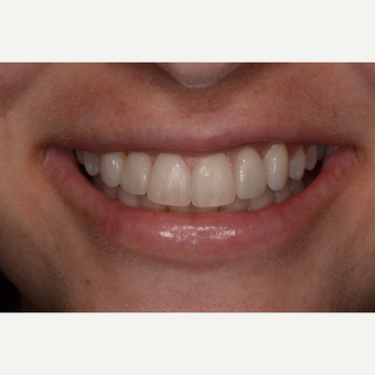 45-54 year old woman treated with Invisalign after 3736030