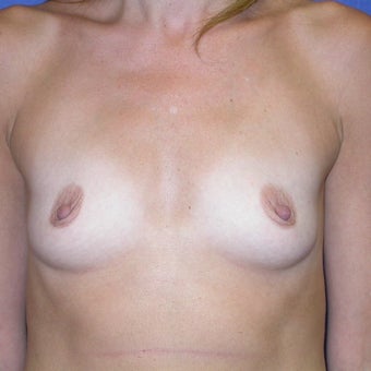 450 cc Silicone Breast Implants before 2451725