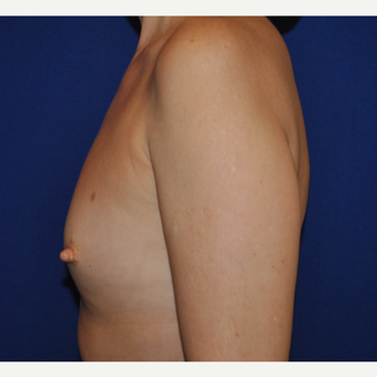 50 year old woman treated with Breast Augmentation before 3776272