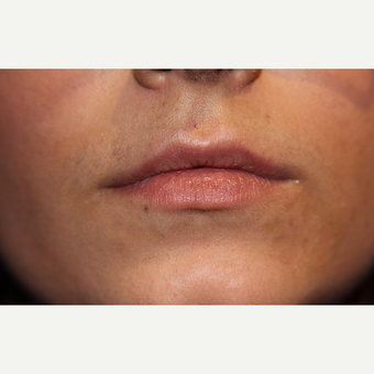 18-24 year old woman treated with Lip Augmentation before 3147336