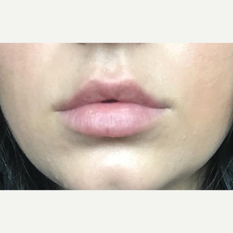 18-24 year old woman treated with Lip Augmentation after 3147336