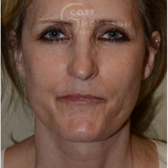 45-54 year old woman treated with Facelift after 3294340