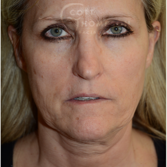 45-54 year old woman treated with Facelift before 3294340