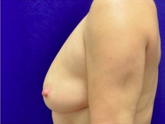 45-54 year old woman treated with Fat Transfer 2280017